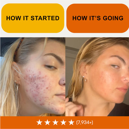 Kill Acne & Redness Ritual - Bundle